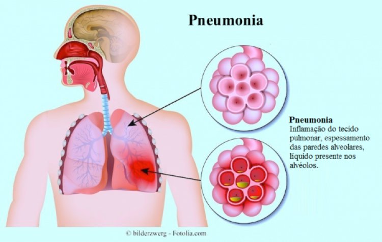 Trabalho sobre a Pneumonia